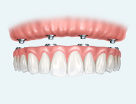 all on 4 implants