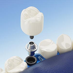 dental implants services