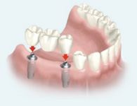 implant supported bridge