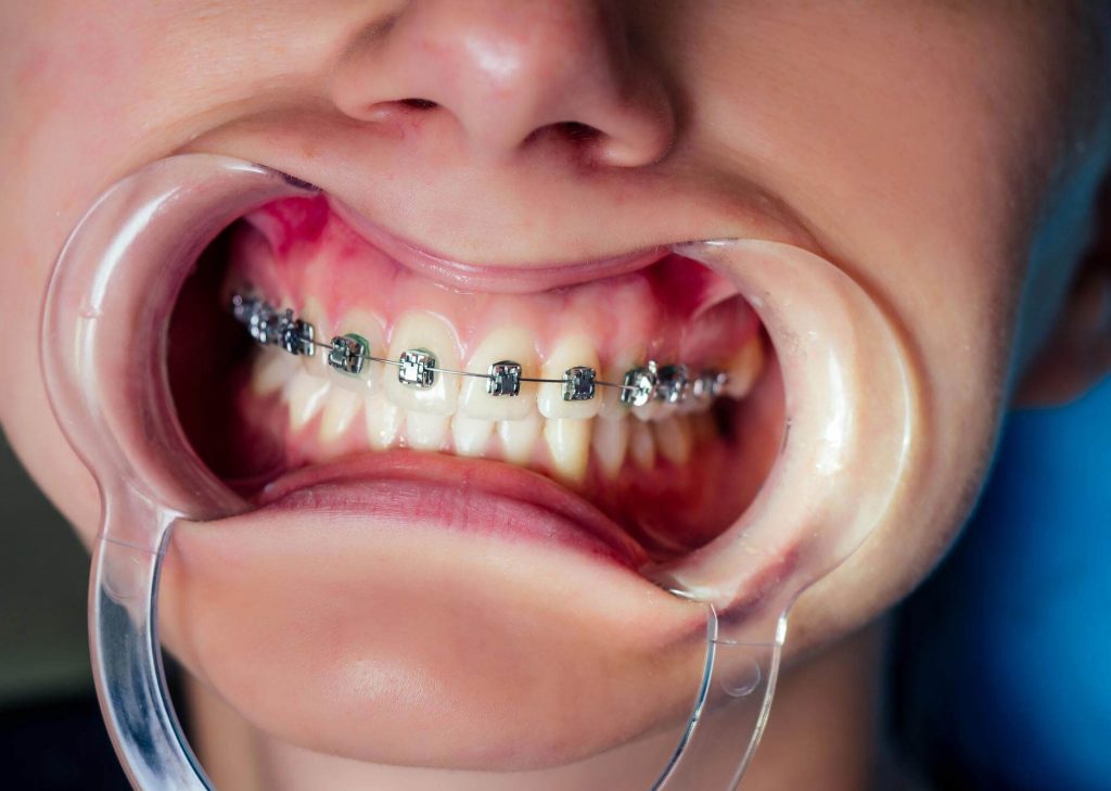 Orthodontist in Vancouver