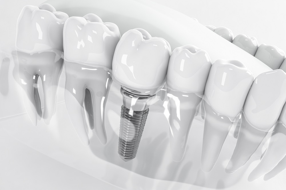 Popular Tooth Replacement Options to Restore Your Smile