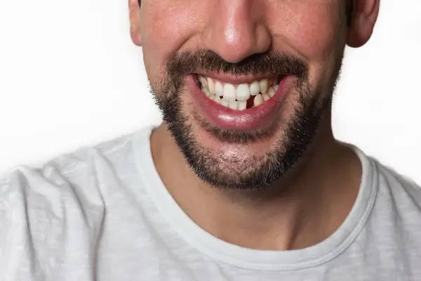 Replacing Missing Teeth
