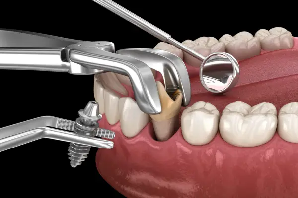 Dental implant placement in the mouth