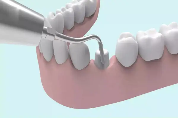 dental bridge and your option